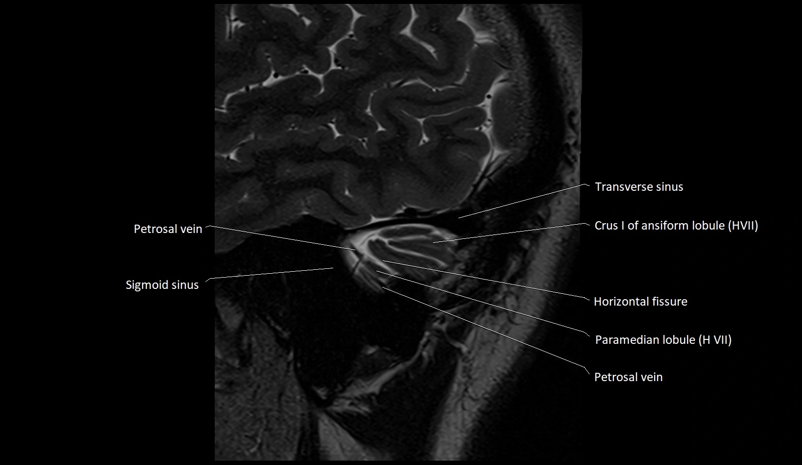MRI Cerebellar anatomy sagittal High-resolution labelled image 3.webp